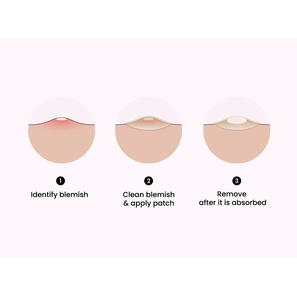 Hydrocolloid Acne Pimples Patches for Face 48 Patches (2 sizes 10mm 12mm) - Picture 3 of 6